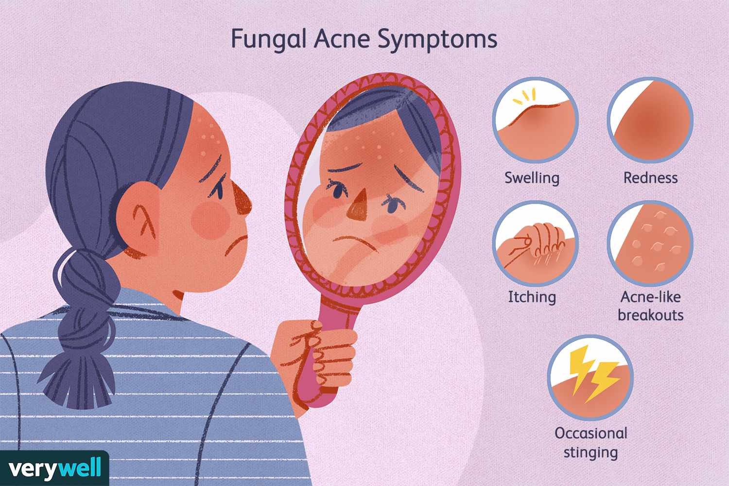 Folliculitis vs Acne: Why Those Tiny Bumps May Not Be Pimples